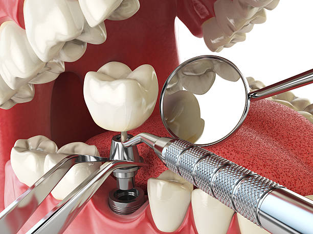 Best Emergency Root Canal Treatment in Farragut, TN